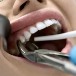 can i use a straw 7 days after tooth extraction