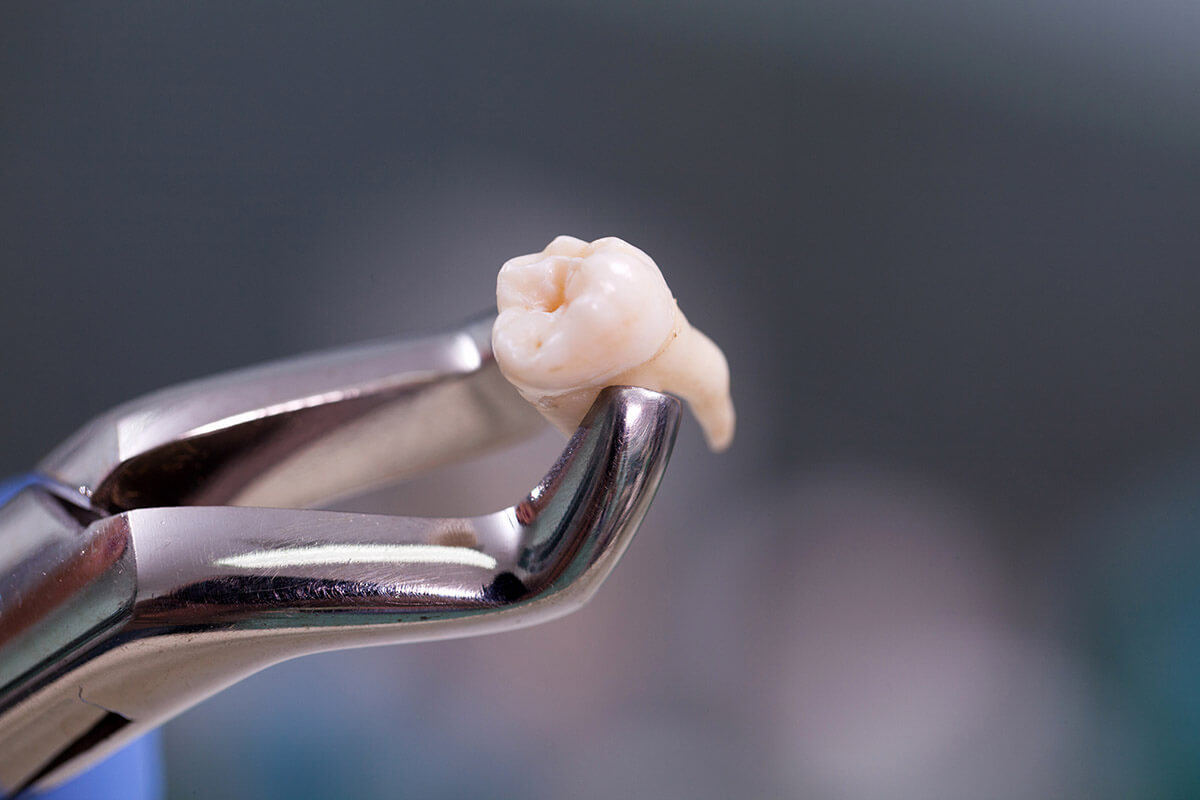 how much does it cost to remove wisdom teeth