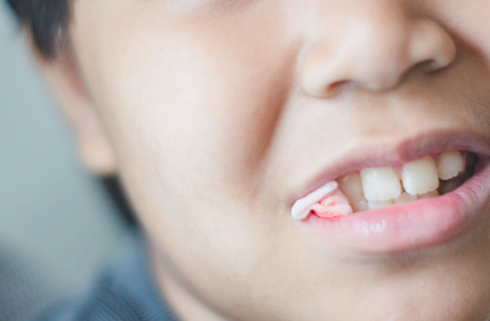 when to stop using gauze after wisdom tooth extraction