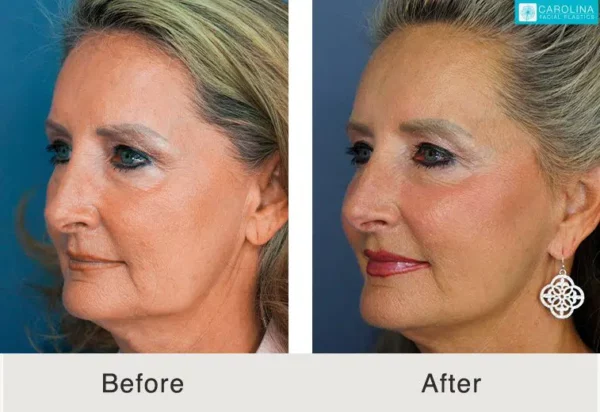 neck lift lower facelift recovery pictures day by day