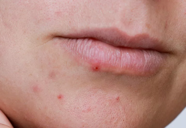 how to get rid of pimple on lip