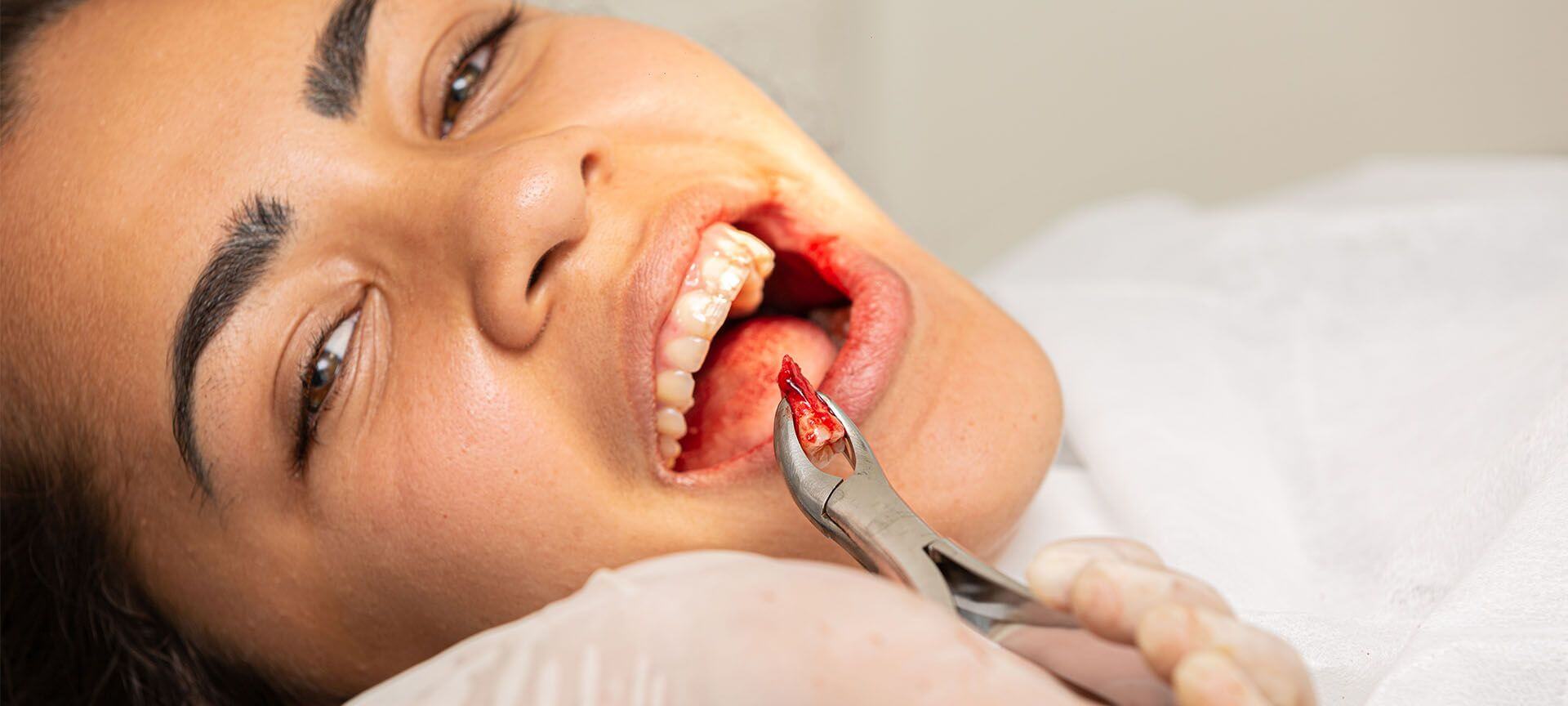 how much does it cost to get wisdom teeth removed